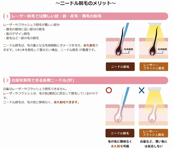 ニードル脱毛のメリットレーザーフラッシュ脱毛のデメリット